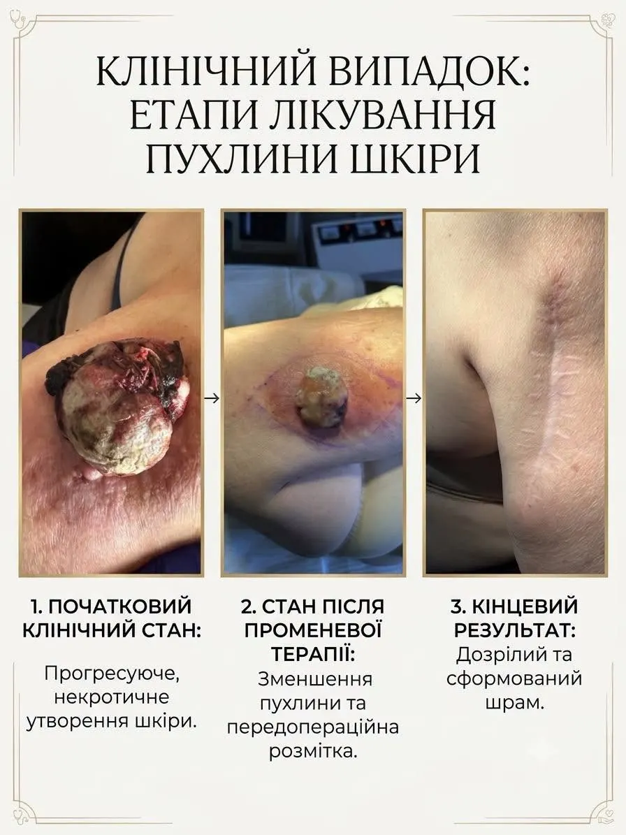 У Франківську жінці видалили злоякісну пухлину, що маскувалася під папілому